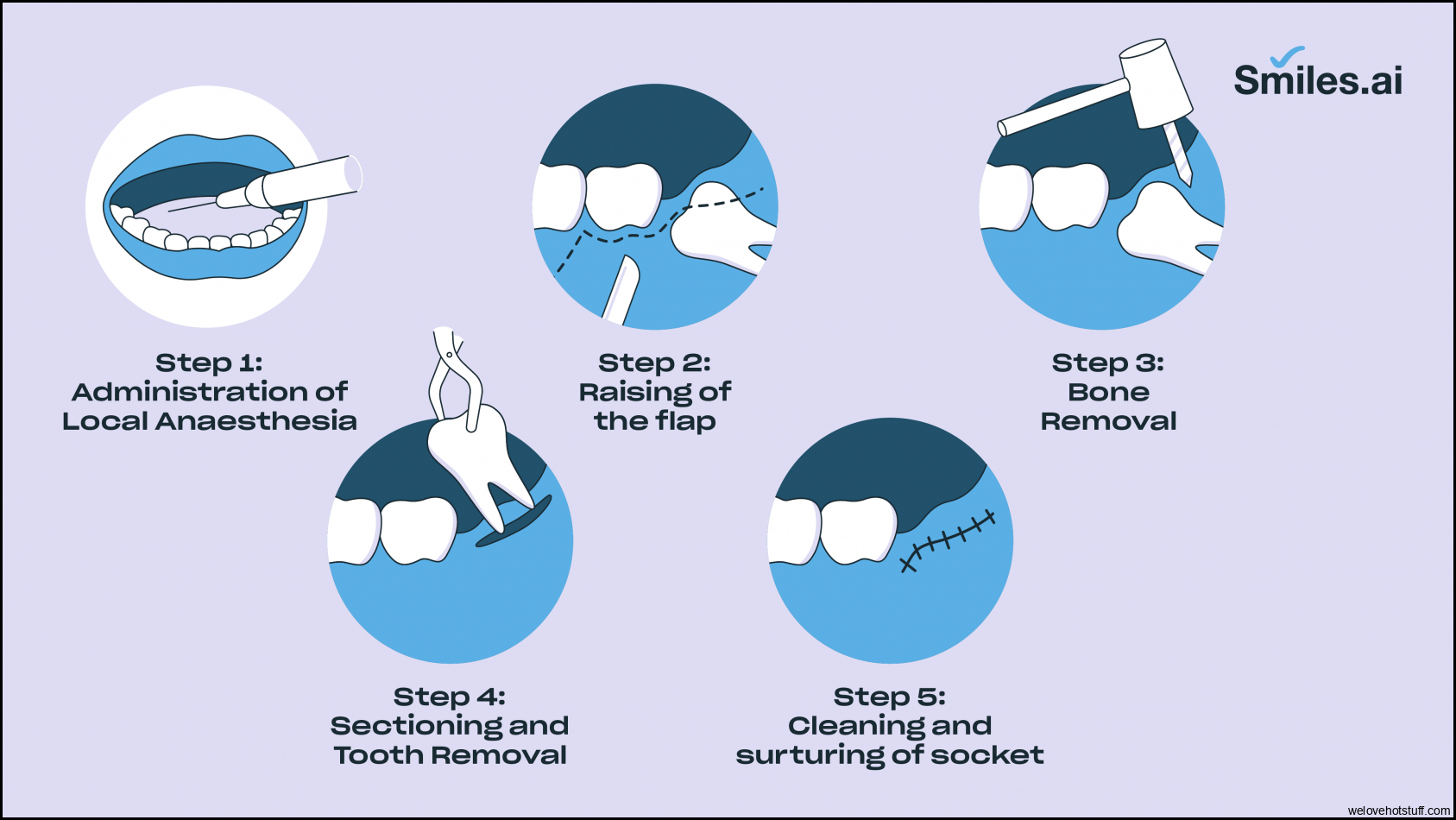 Everything you need to know about the Wisdom tooth extraction